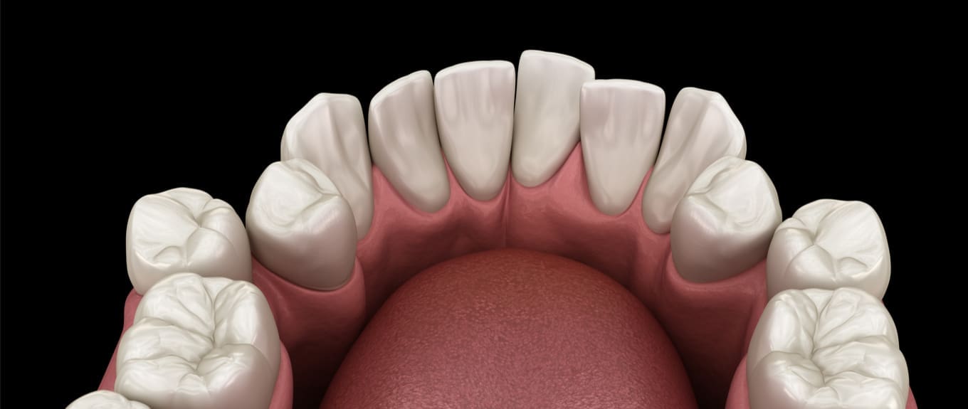 A Massive Cochrane review on Orthodontic treatment for crowding