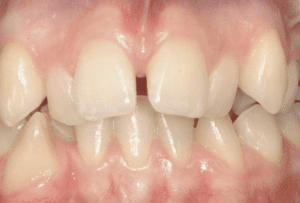 Before 24 Month Smiles