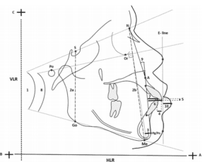 Cephalometric analysis