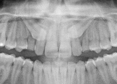 canines - Kevin O'Brien's Orthodontic Blog Impacted canines not shown on CBCT