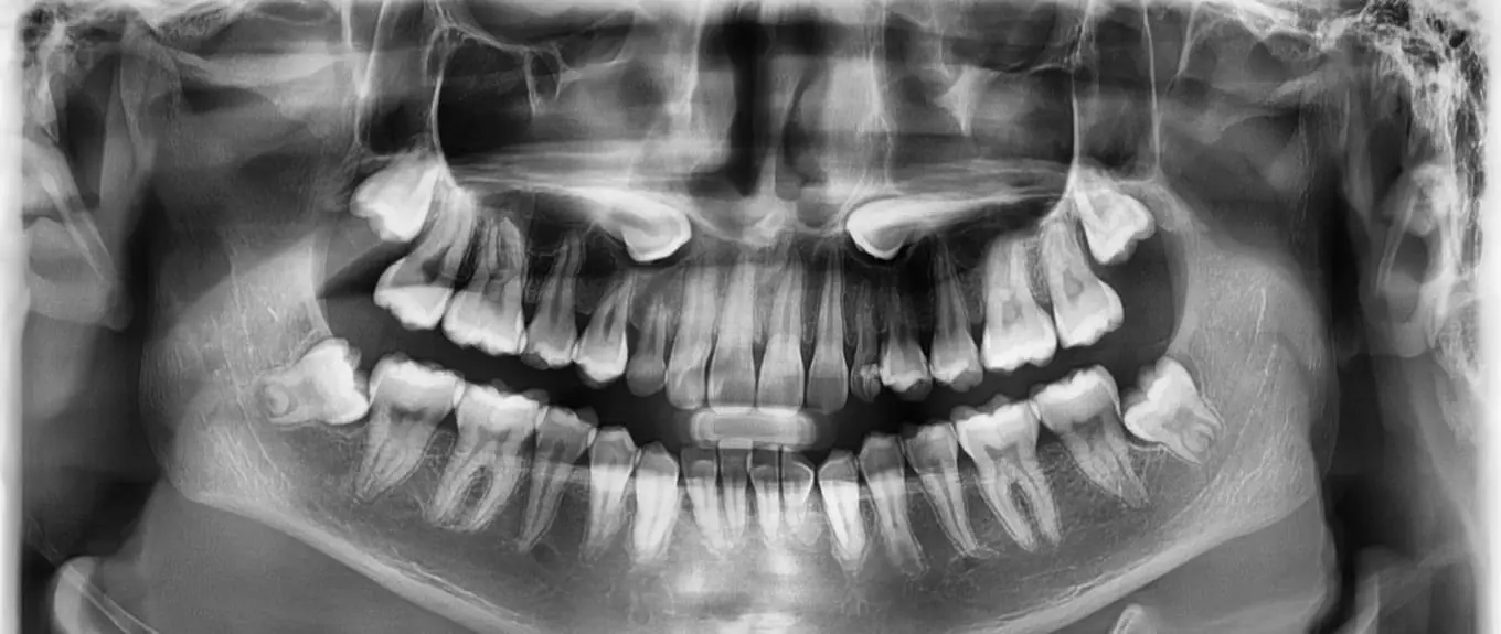 Palatally Displaced Canines