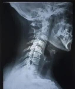 cervical growth