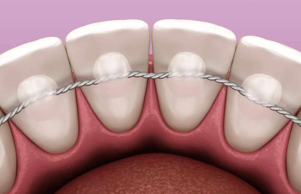 Retainers,Dental,Installed,After,Braces,Treatment,,Medically,Accurate,Dental,3d - Kevin O'Brien's Orthodontic Blog