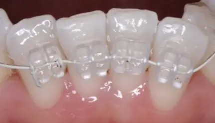 Alignment 1 copy - Kevin O'Brien's Orthodontic Blog alignment