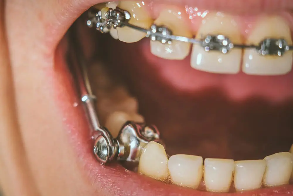 Dental,Appliance,For,Deep,Bite - Kevin O'Brien's Orthodontic Blog Herbst appliance