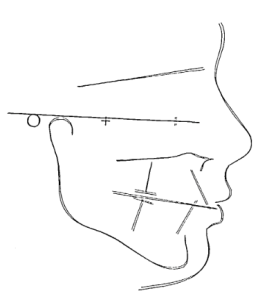 Facial profile tracing