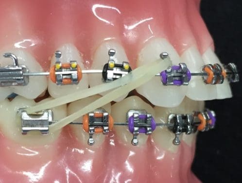 Set Fasce 28#-44 340 Pezzi Fasce Tubi Buccali Ortodontici - Per 1° Molare, Sistema Roth .022, Saldate Conv Filo Interdentale Oral B - Foto 7