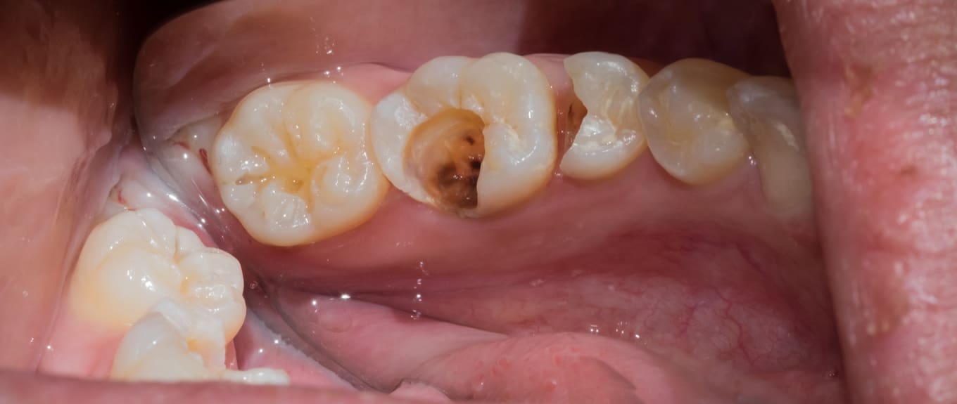  caries treatment primary teeth