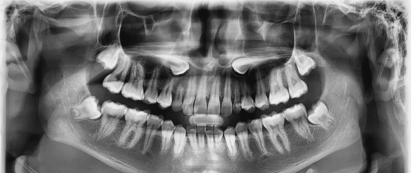 dental-canine-guidance-in-2020-dentistry-dental-human-teeth