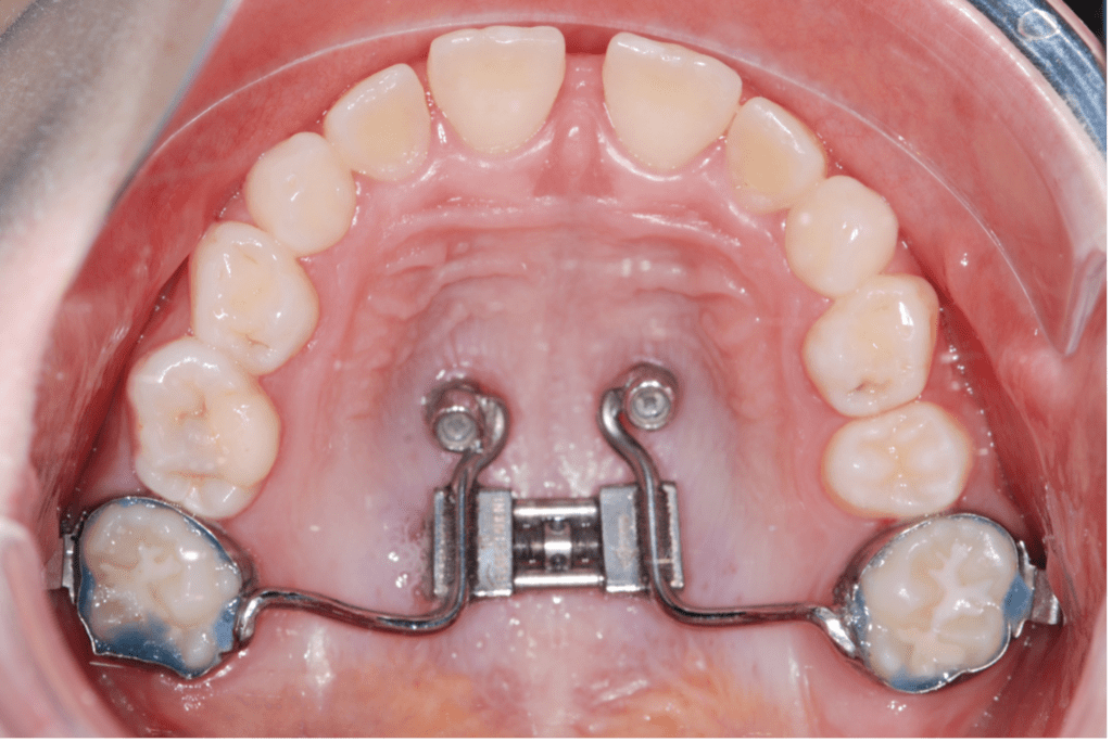 Maxillary Expansion with skeletal anchorage explained MSE vs Hybrid