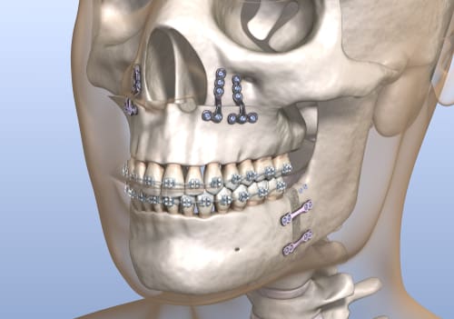 TADs or surgery for correcting AOBs: More or less stable? - Kevin O'Brien's  Orthodontic Blog