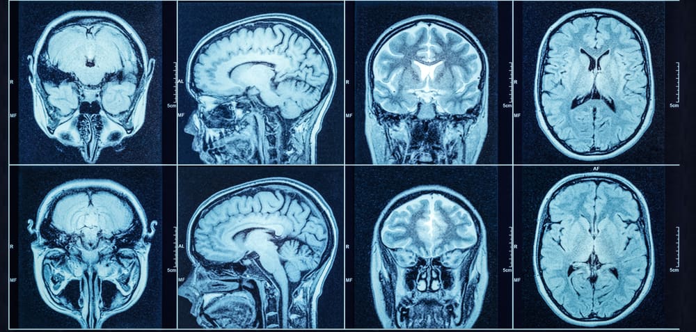 Brain Cancer After Ct Examinations Of Children And Young Adults 