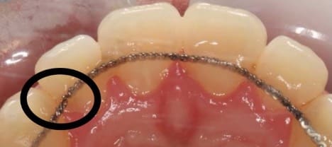 retainer - Kevin O'Brien's Orthodontic Blog retainers