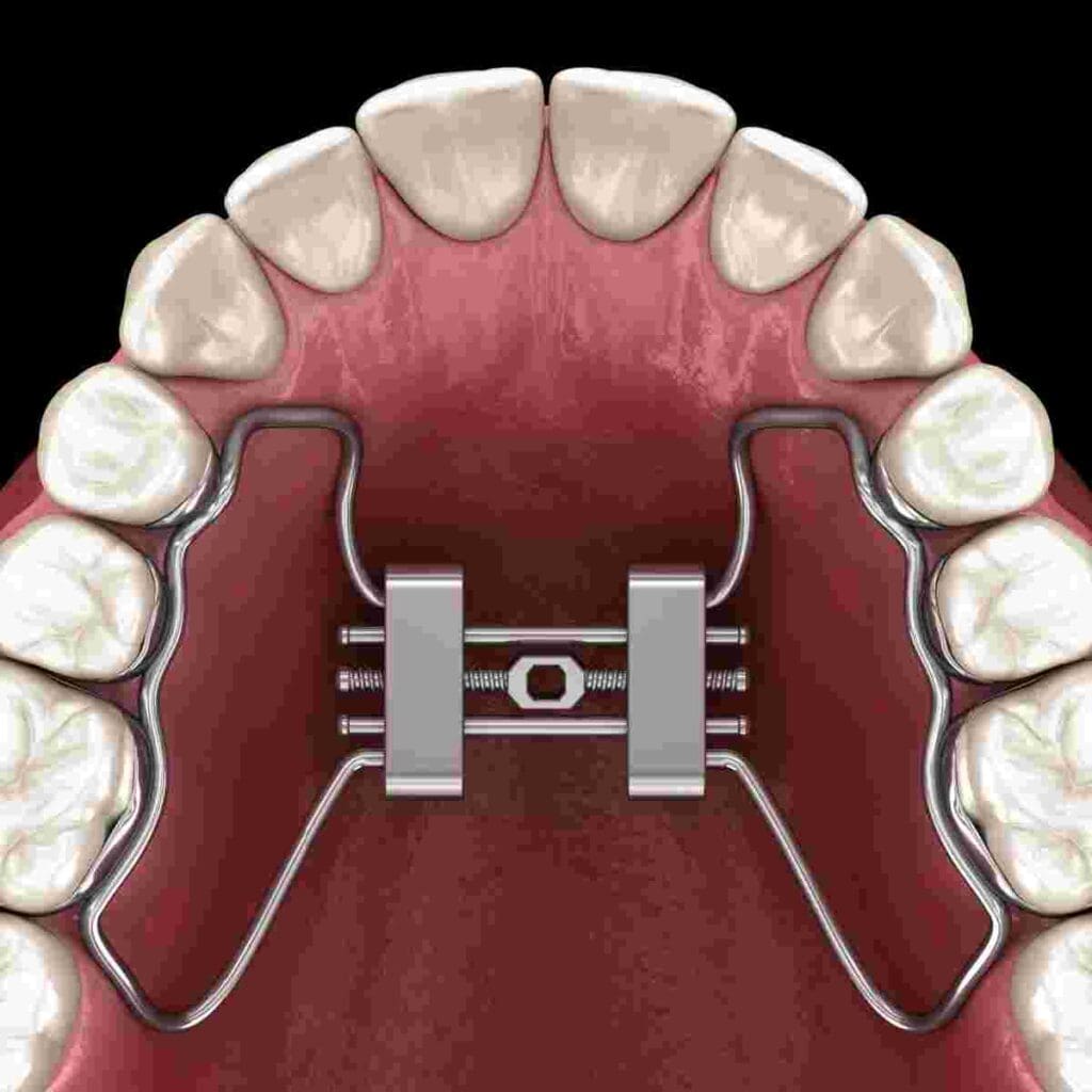 RPE small - Kevin O'Brien's Orthodontic Blog adenotonsillectomy
