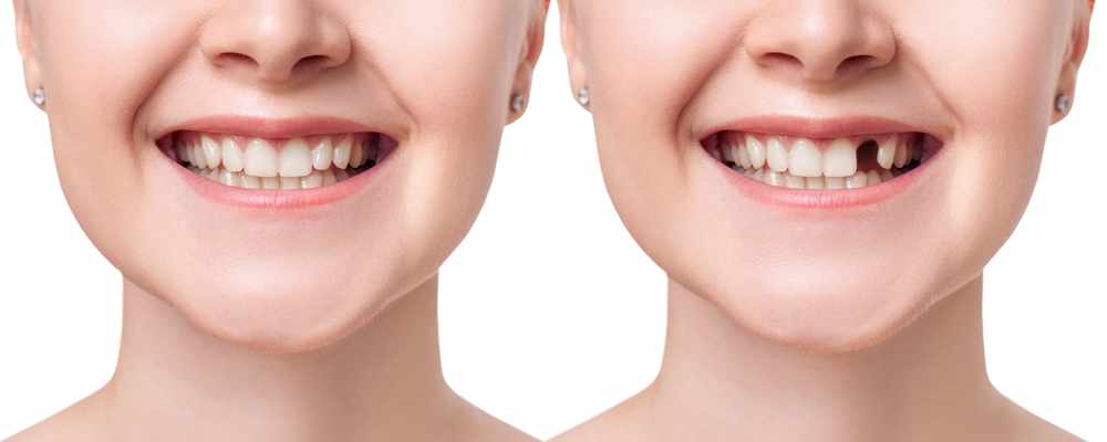 An orthodontic perspective on replacing missing maxillary incisors ...